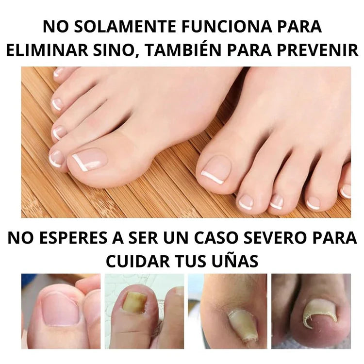 Tratamiento para eliminar Hongos de uña 100% Natural🍃
